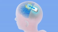 植入式脑机接口公司微灵医疗获数千万元天使轮融资，果壳跟投